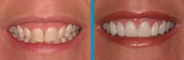 porcelain veneers before and after photos