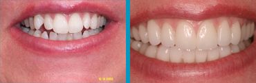 before and after smile makeover